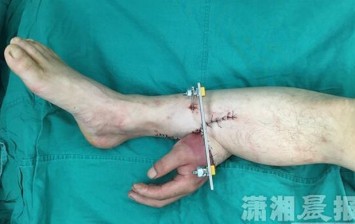 doctors-save-mans-severed-hand-by-attaching-it-to-his-leg.