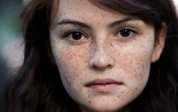 People Have Freckles