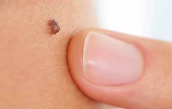 skin mole