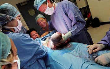 caesarean sections