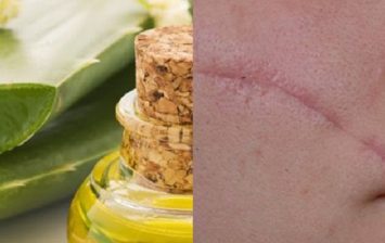 removing scars remedies